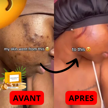 Savon Anti-Acné Curcuma & Kojic – Peau Nette, Éclatante & Sans Imperfections